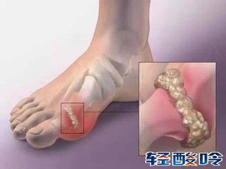 惊!痛风有这些并发症你都知道吗?